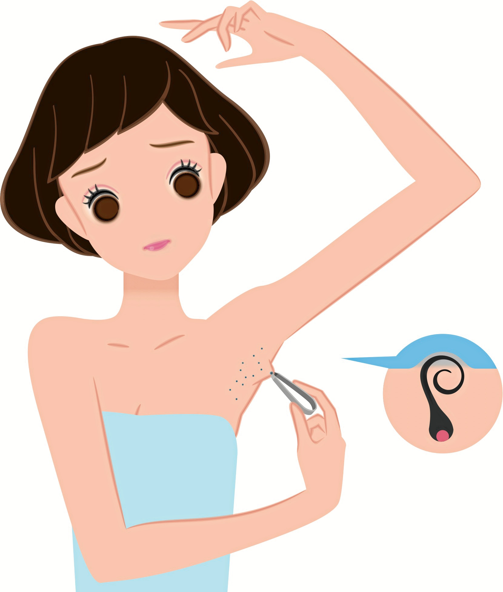 Et indgroet hår opstår når et hår gror tilbage ind i huden, i stedet for gennem overfladen.